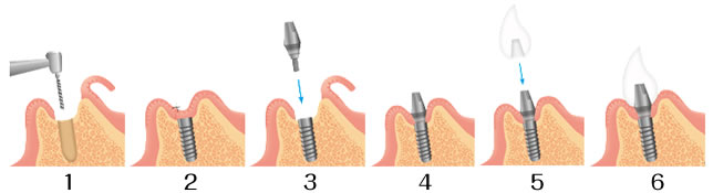 インプラント治療の流れ 