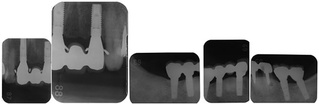 術後インプラント周囲のレントゲン検査 