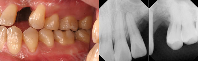 インプラント症例2