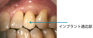 インプラント適応部