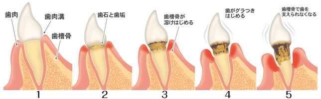 歯周病進行の流れ 